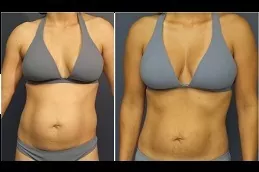 BRAVA Breast Augmentation in Dubai