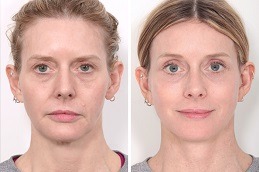 Best Brow Lift Surgery Cost in Dubai