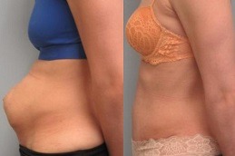 Best Circumferential Abdominoplasty Cost Dubai
