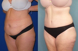 Best Circumferential Abdominoplasty Cost in Dubai