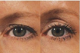 Best Clinic of Botox Brow Lift for Hooded Eyes Dubai