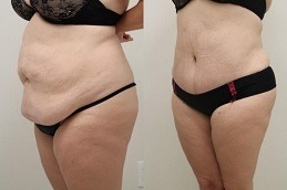 Best Clinic of Circumferential Abdominoplasty Cost Dubai