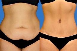 Best Clinic of Circumferential Abdominoplasty Cost in Dubai