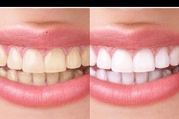 Best Clinic of Dental Stain Removal Cost Dubai