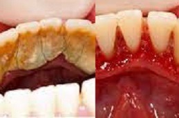 Best Clinic of Dental Stain Removal Cost in Dubai
