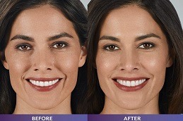 Best Clinic of Filler Injection for The Forehead and Temples Dubai