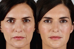 Best Clinic of Filler Injection for The Forehead and Temples in Dubai