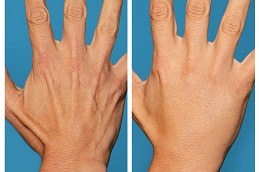 Best Clinic of Hand Wrinkles Treatment Dubai UAE
