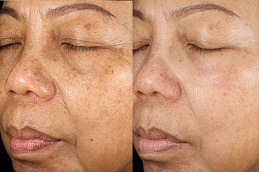 Best Clinic of Hyperpigmentation Treatment for Black Skin Dubai