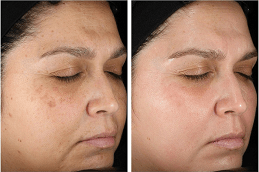 Best Clinic of Hyperpigmentation Treatment for Black Skin in Dubai