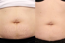 Best Clinic of Laser Stretch Marks Removal Cost Dubai & Abu Dhabi