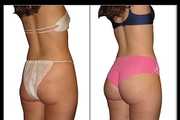 Best Clinic of Non-Surgical Bum Lift Cost in Dubai & Abu Dhabi