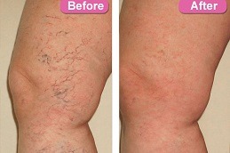 Best Clinic of Spider Veins Laser Treatment Cost in Dubai