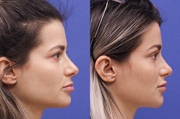 Best Filler Injection for The Forehead and Temples Dubai