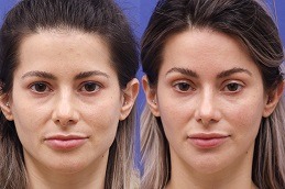 Best Filler Injection for The Forehead and Temples in Dubai