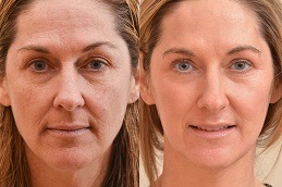 Best Laser Skin Resurfacing Cost in Dubai