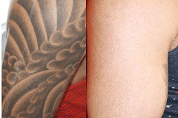 Best Picosure Tattoo Removal Cost in Dubai