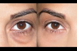 Best under-eye-bag-treatment-cost Clinic in Dubai