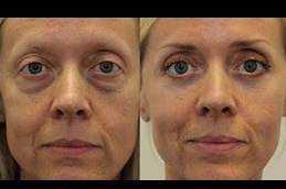 Best under-eye-bag-treatment-cost in Abu Dhabi