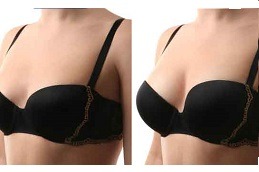 Breast Reconstruction Abu Dhabi