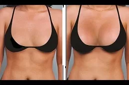Breast Reconstruction Clinic in Dubai