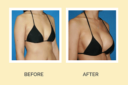 Breast Reconstruction Dubai