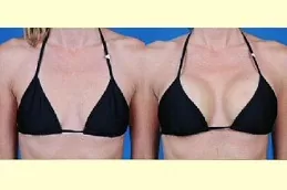 Breast Reconstruction in Abu Dhabi