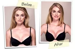 Breast Reconstruction in Dubai