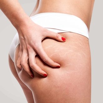 Cellfina Treatment Cost in Dubai