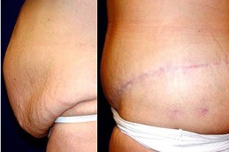 Circumferential Abdominoplasty Cost Dubai