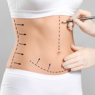 Circumferential Abdominoplasty Cost in Dubai