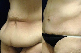 Circumferential Abdominoplasty Cost in Dubai