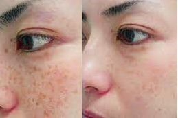 Cryotherapy Dubai 