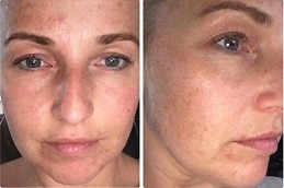 Cryotherapy Treatment