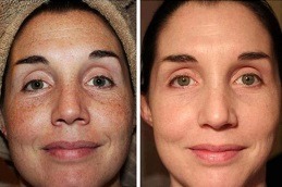 Cryotherapy treatment in Dubai 