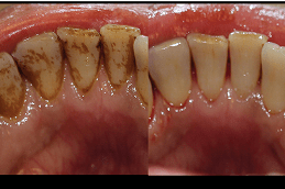 Dental Stain Removal Cost Dubai