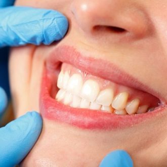 Dental Stain Removal Cost in Dubai
