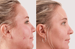Exilis Treatment Clinic in Abu Dhabi