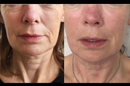 Exilis Treatment Clinic in Dubai