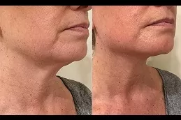 Exilis Treatment Dubai & Abu Dhabi