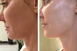 Exilis Treatment Dubai