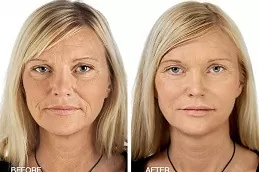 Exilis Treatment in Abu Dhabi