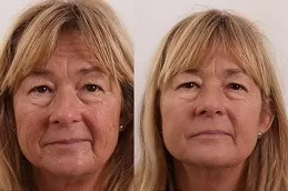 Exilis Treatment in Dubai