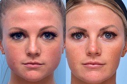 Filler Injection for The Forehead and Temples Dubai