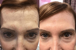Filler Injection for The Forehead and Temples in Dubai