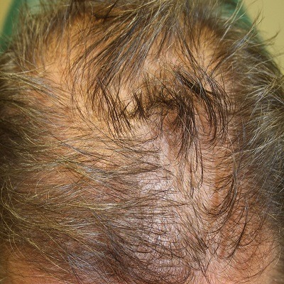 GFC Treatment For Hair In Dubai Hair Regrowth Treatment
