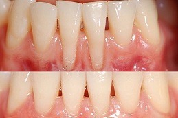 Gum Bleeding Treatment Clinic Abu Dhabi