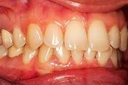 Gum Bleeding Treatment Clinic Dubai