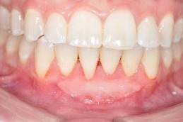 Gum Bleeding Treatment Dubai & Abu Dhabi