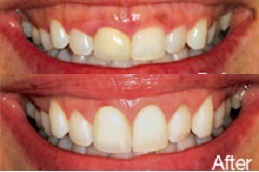 Gum Bleeding Treatment in Abu Dhabi